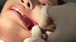 歯フェチ！本物の歯治療映像【抜歯】 ミランダ